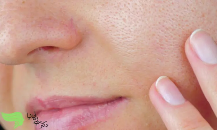 فیشیال صورت و تاثیر آن بر بستن منافذ باز پوست