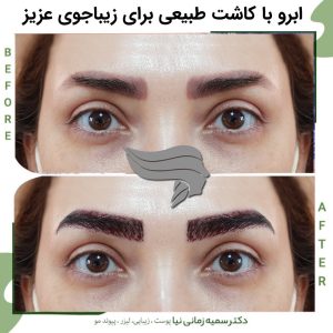 کاشت ابرو دکتر زمانی