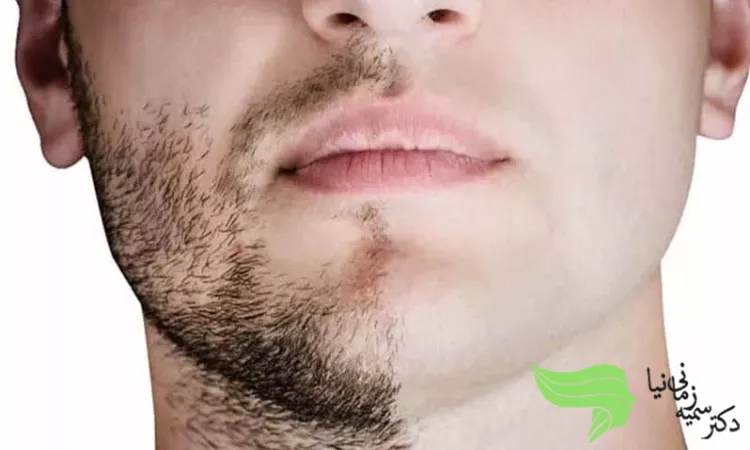 بعد از کاشت ریش چه مراقبت هایی کنیم