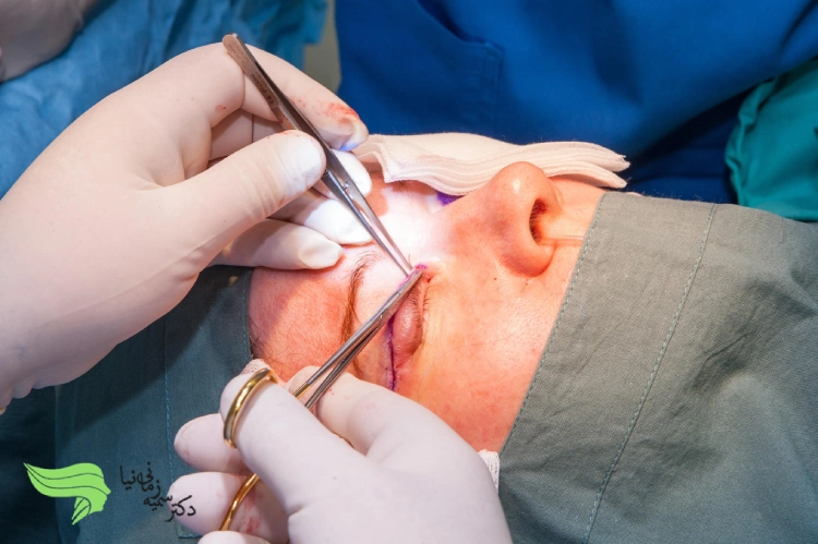 بلفاروپلاستی چه معایبی دارد