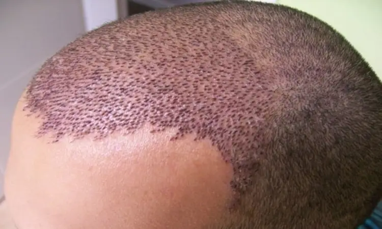 بهترین سن برای کاشت مو در مردان