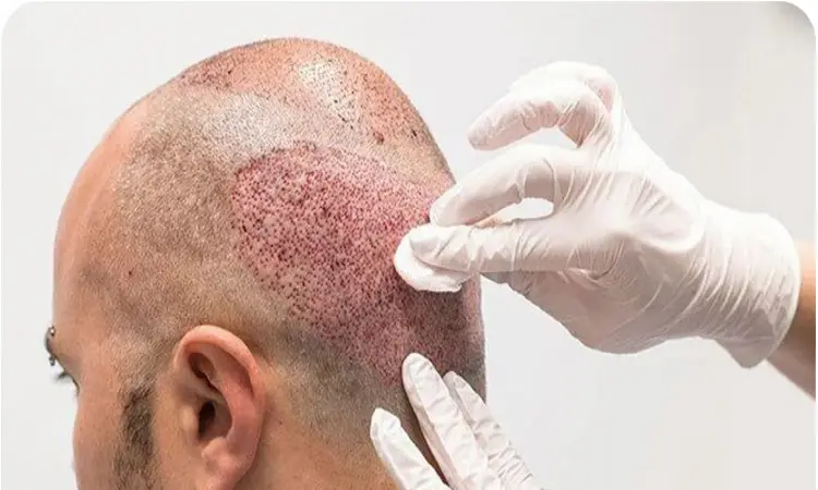 بهترین سن کاشت مو آقایان