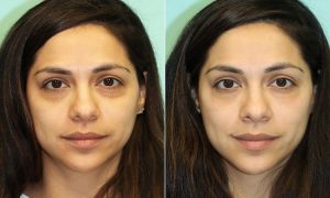 تزریق بوتاکس برای گودی زیر چشم