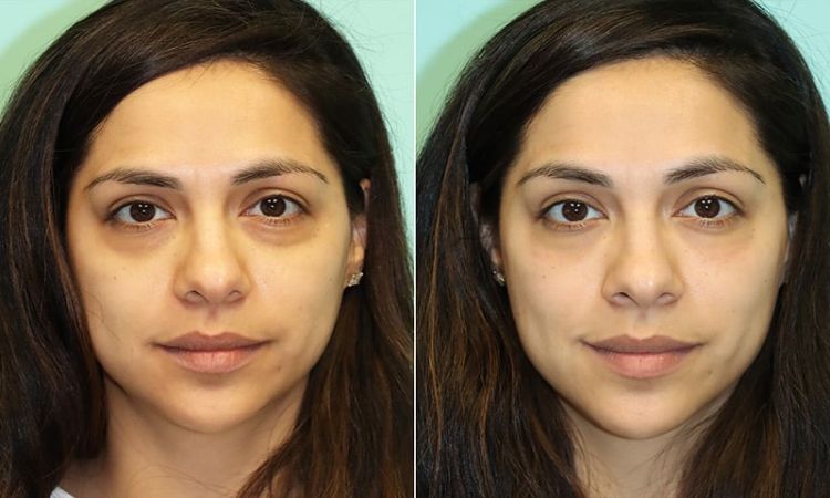تزریق بوتاکس برای گودی زیر چشم