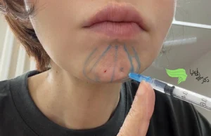 تزریق بوتاکس چانه