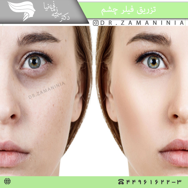 تزریق فیلر زیر چشم