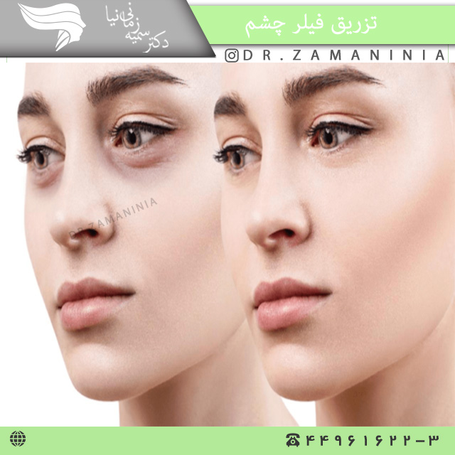 مزایای تزریق فیلر زیر چشم