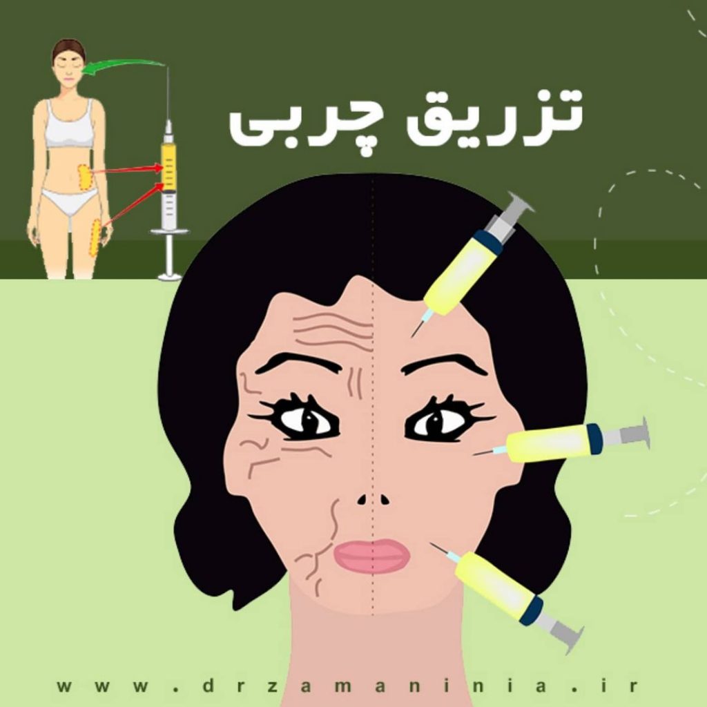 تزریق چربی چیست