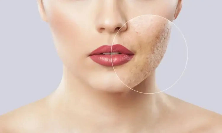 تزریق ژل برای جای جوش