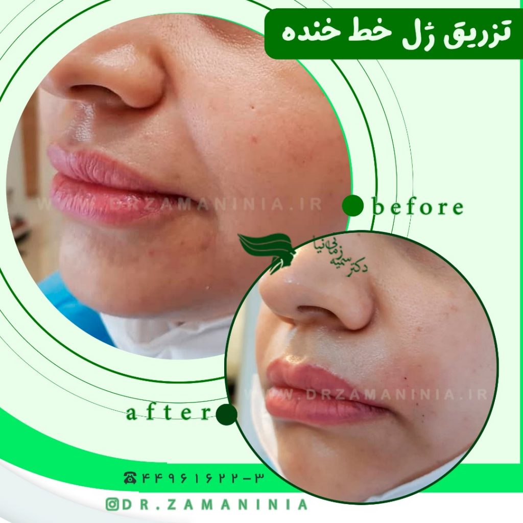 تزریق فیلر خط خنده