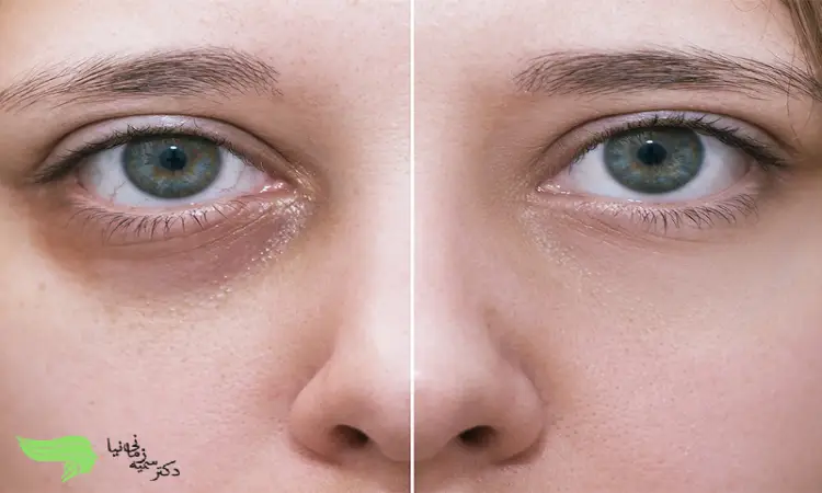 درمان گودی زیر چشم