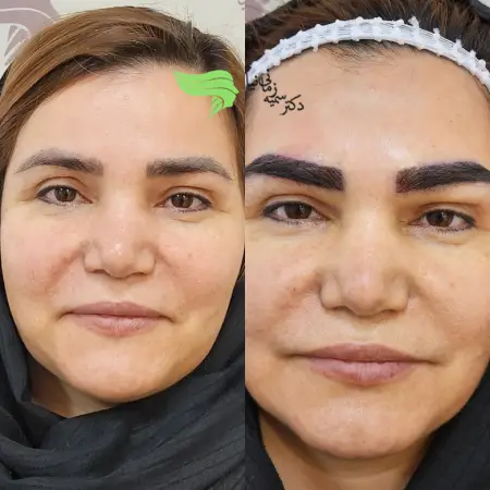 دوران نقاهت بعد از کاشت ابرو