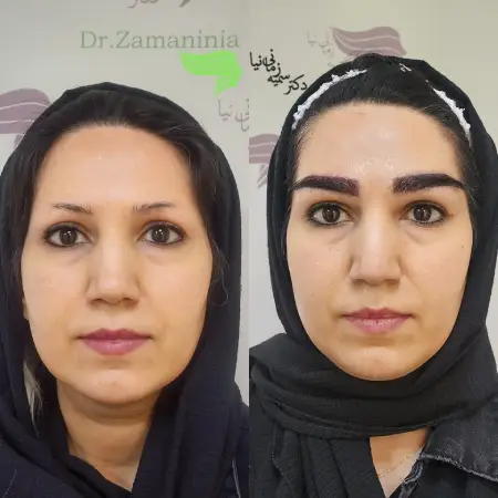 دوره نقاهت بعد از کاشت ابرو