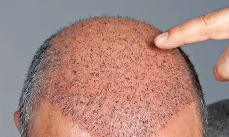 روش خوابیدن بعد از کاشت مو