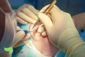 عدم تقارن پلک بعد از بلفاروپلاستی