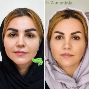 قبل و بعد کاشت ابرو4
