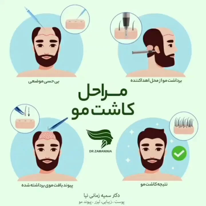مراحل انجام کاشت مو طبیعی