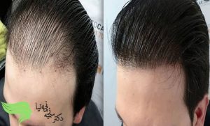 مزایا و معایب کاشت مو به روش های مختلف