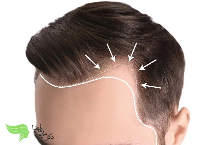 مزایای کاشت مو به روش FIT