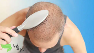 نکته های شانه زدن بعد از کاشتن مو