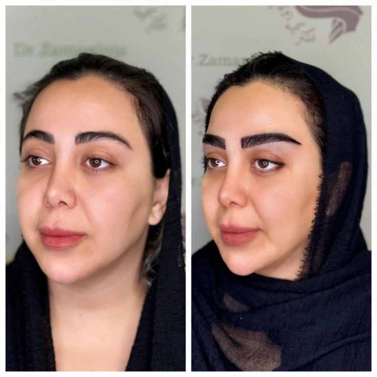 هزینه کاشت ابرو دکترزمانی