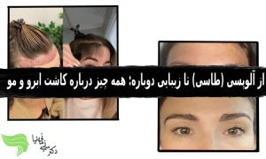 همه چیز درباره آلوپسی کاشت ابرو و مو