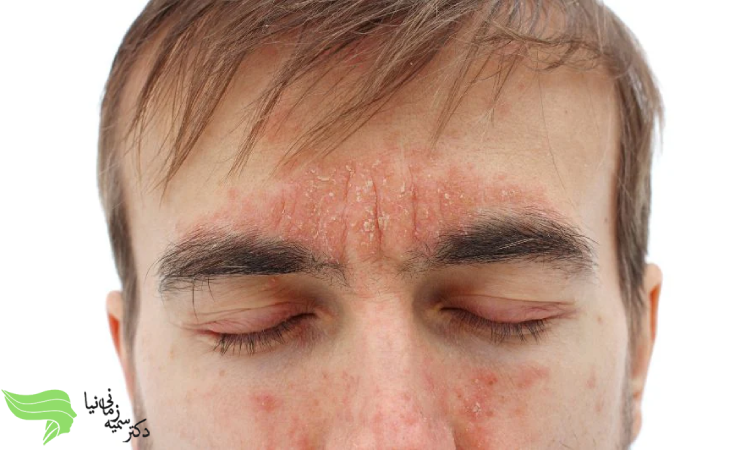 درمان ریزش موی ابرو با کاشت ابرو