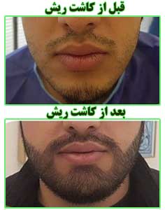 قبل و بعد از کاشت ریش طبیعی