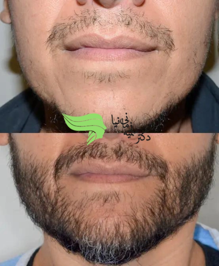 کاشت ریش طبیعی