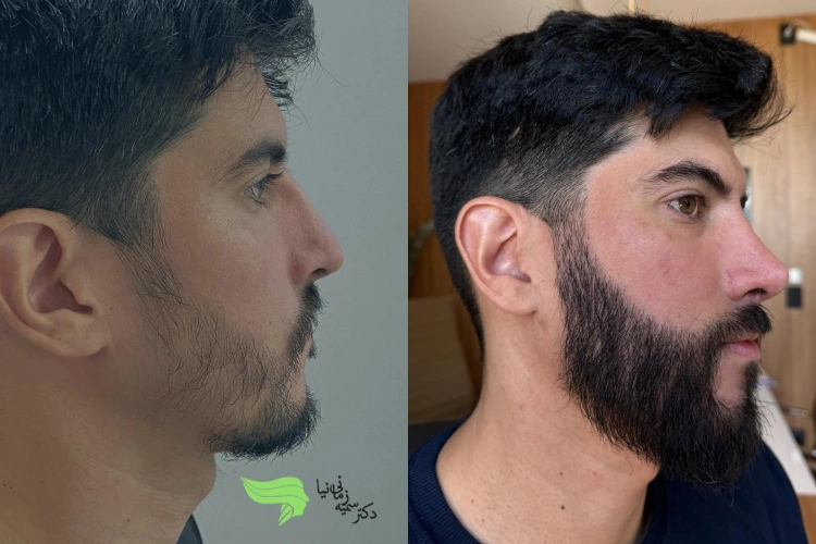 کاشت ریش